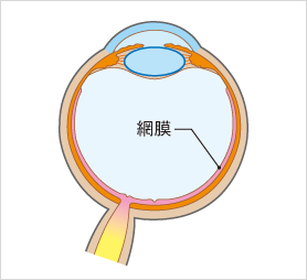 retinal-detachment01